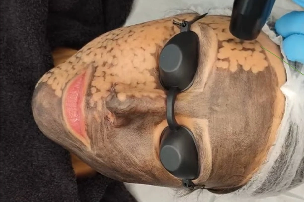 Peelings Rejuvenecedores