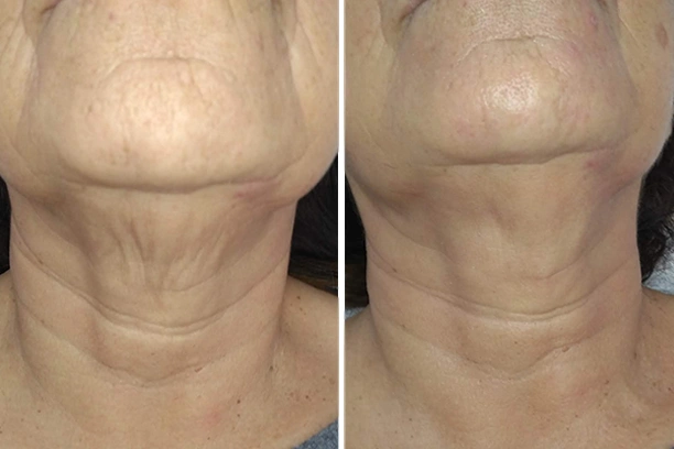 Rejuvenecimiento Ultrasónico Avanzado